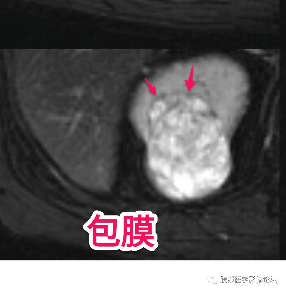【病例】肾脏乳头状肾细胞癌1例CT及MR影像讨论