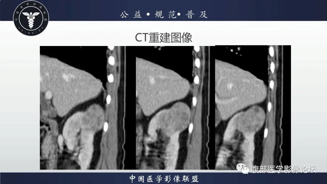 【病例】肾脏乳头状肾细胞癌1例CT及MR影像讨论