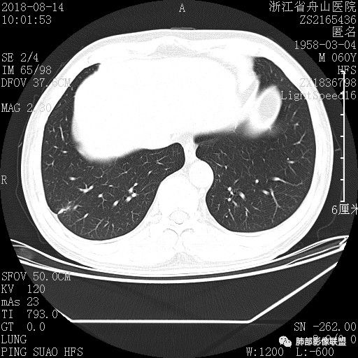 【病例】肺隐球菌病1例CT影像