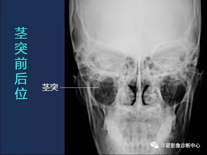 X线解剖图谱+系统解剖（骨骼篇）