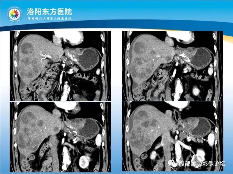 【病例】胃肝样腺癌肝内多发转移1例CT影像 【病例】胃肝样腺癌肝内多发转移1例CT影像