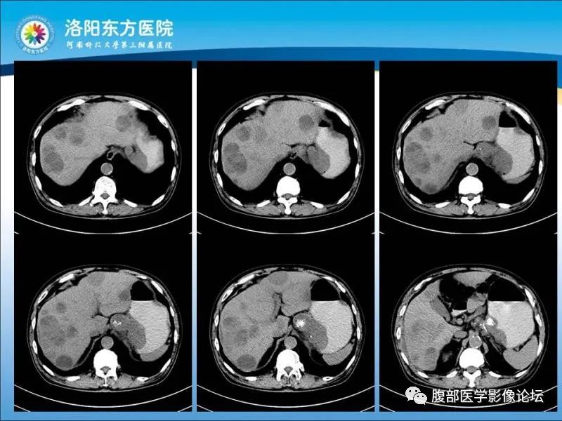 【病例】胃肝样腺癌肝内多发转移1例CT影像 【病例】胃肝样腺癌肝内多发转移1例CT影像