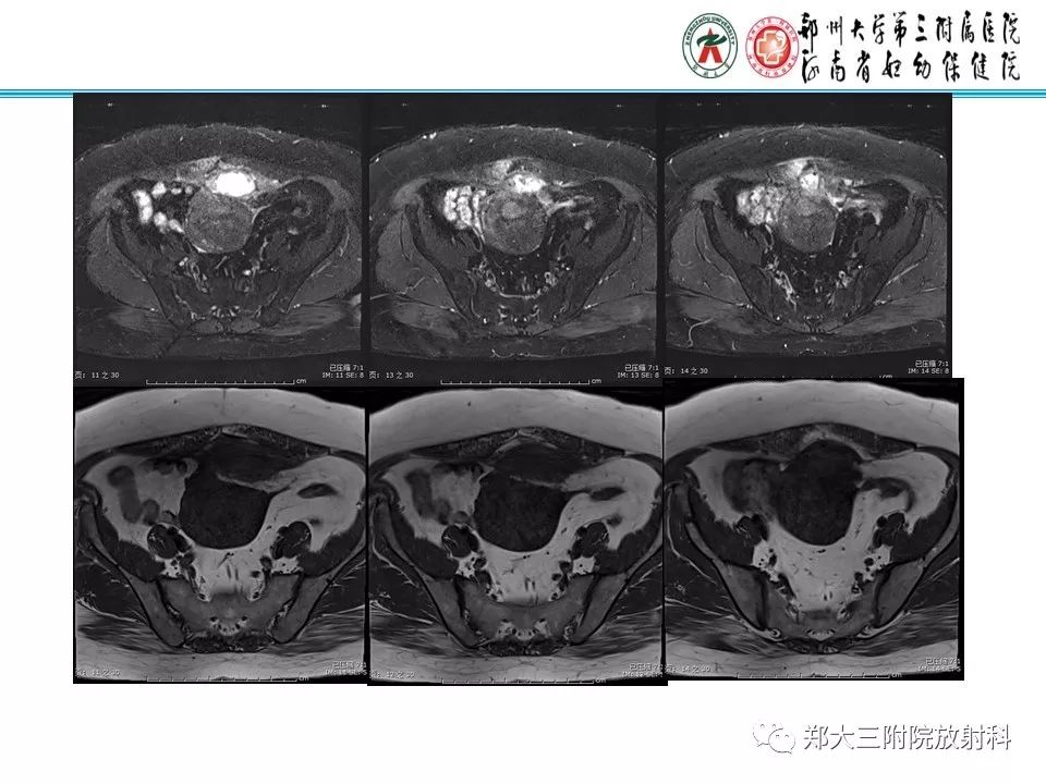 【PPT】腹壁子宫内膜异位症