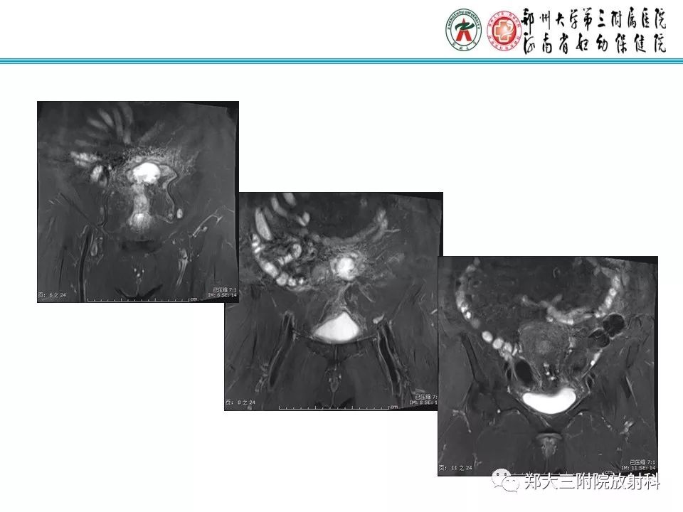 【PPT】腹壁子宫内膜异位症