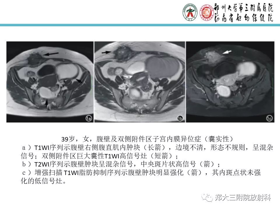 【PPT】腹壁子宫内膜异位症