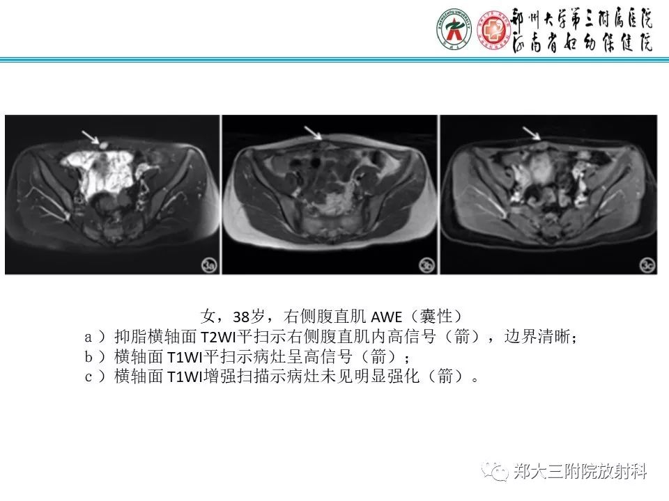 【PPT】腹壁子宫内膜异位症