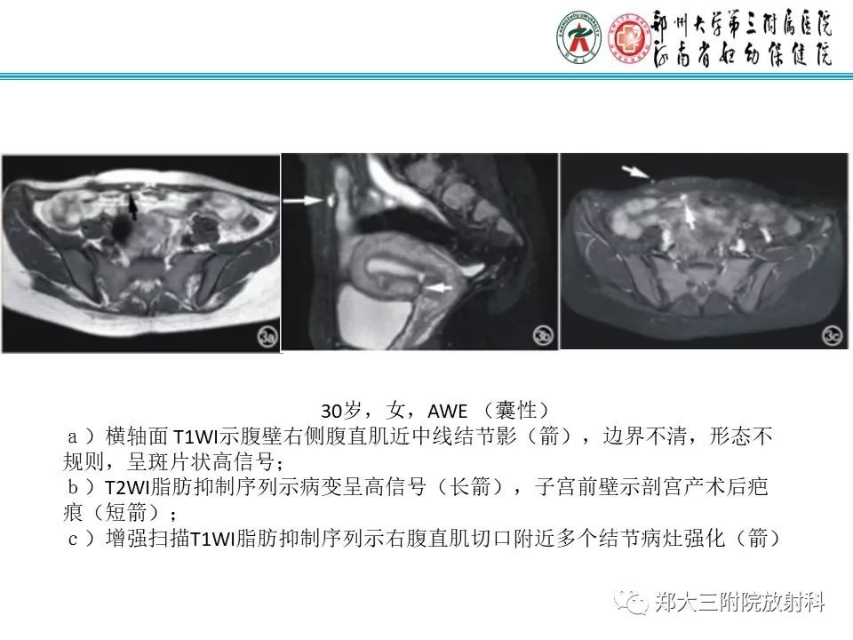 【PPT】腹壁子宫内膜异位症