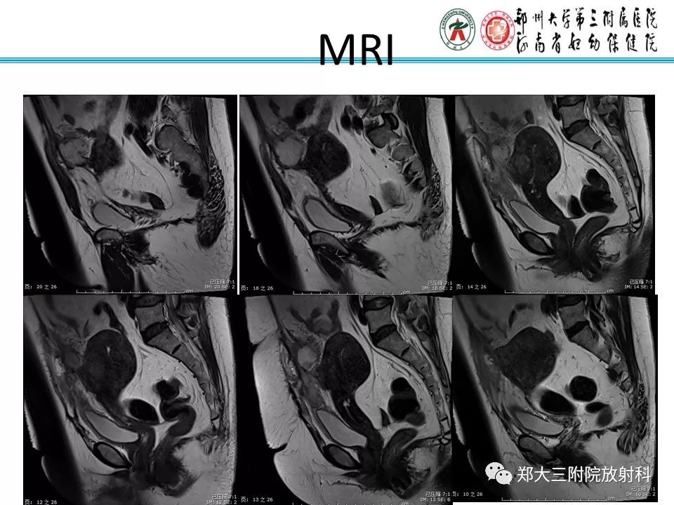 【PPT】腹壁子宫内膜异位症