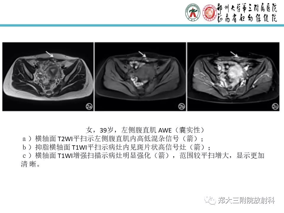 【PPT】腹壁子宫内膜异位症