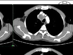 肺不典型类癌1例CT影像讨论