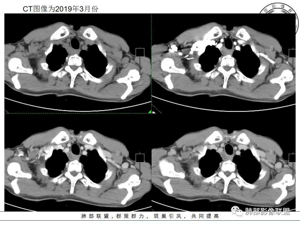 【病例】肺不典型类癌1例CT影像讨论