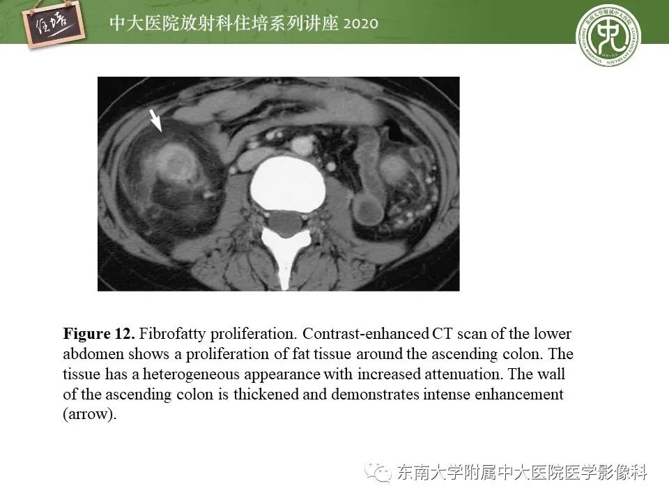 【PPT】腹部淋巴瘤影像诊断及鉴别