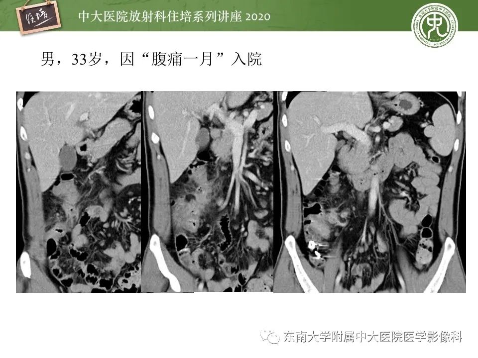 【PPT】腹部淋巴瘤影像诊断及鉴别