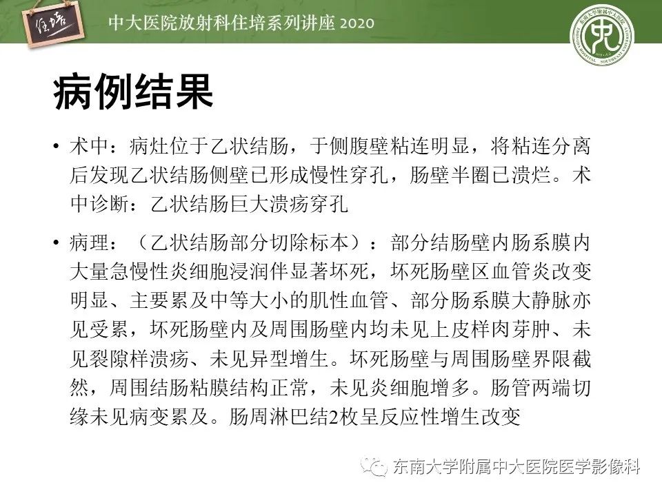 【PPT】腹部淋巴瘤影像诊断及鉴别