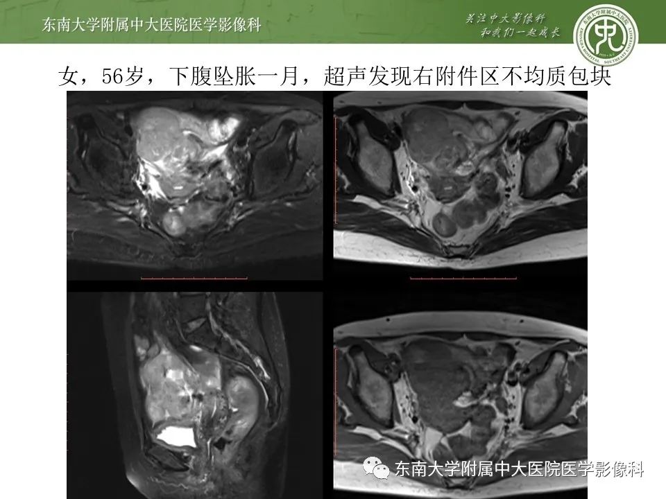 【PPT】腹部淋巴瘤影像诊断及鉴别