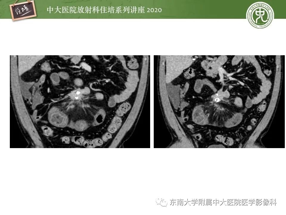 【PPT】腹部淋巴瘤影像诊断及鉴别