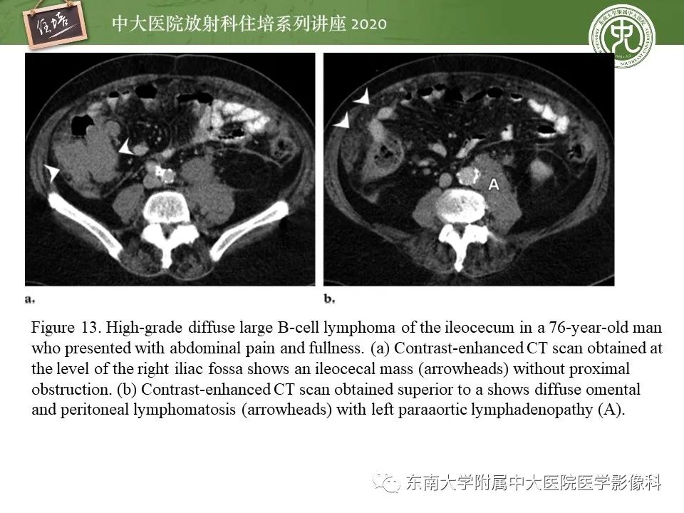 【PPT】腹部淋巴瘤影像诊断及鉴别