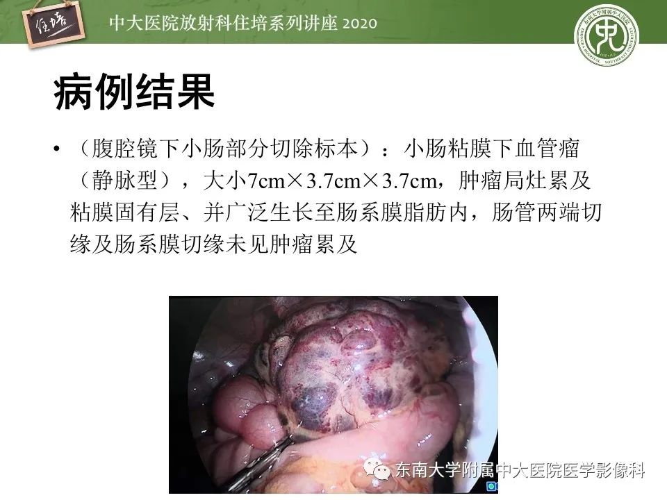 【PPT】腹部淋巴瘤影像诊断及鉴别
