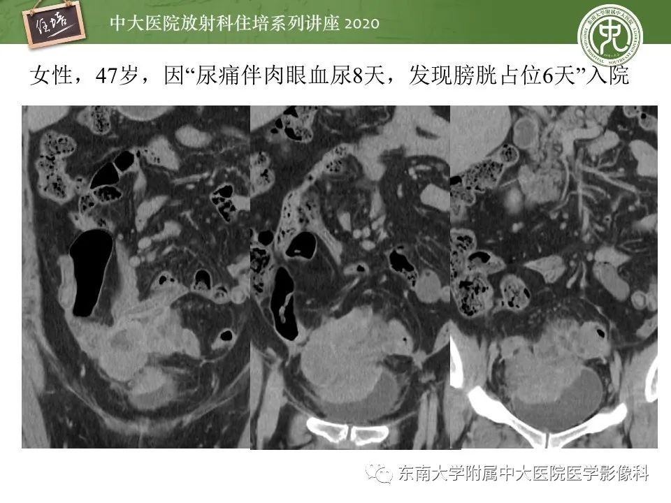 【PPT】腹部淋巴瘤影像诊断及鉴别