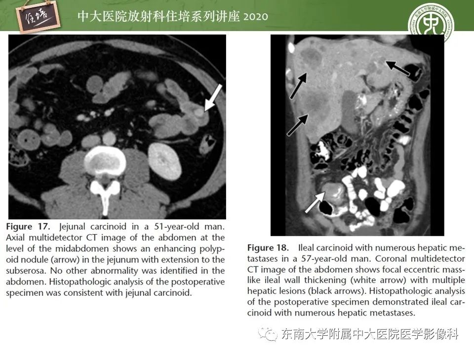 【PPT】腹部淋巴瘤影像诊断及鉴别
