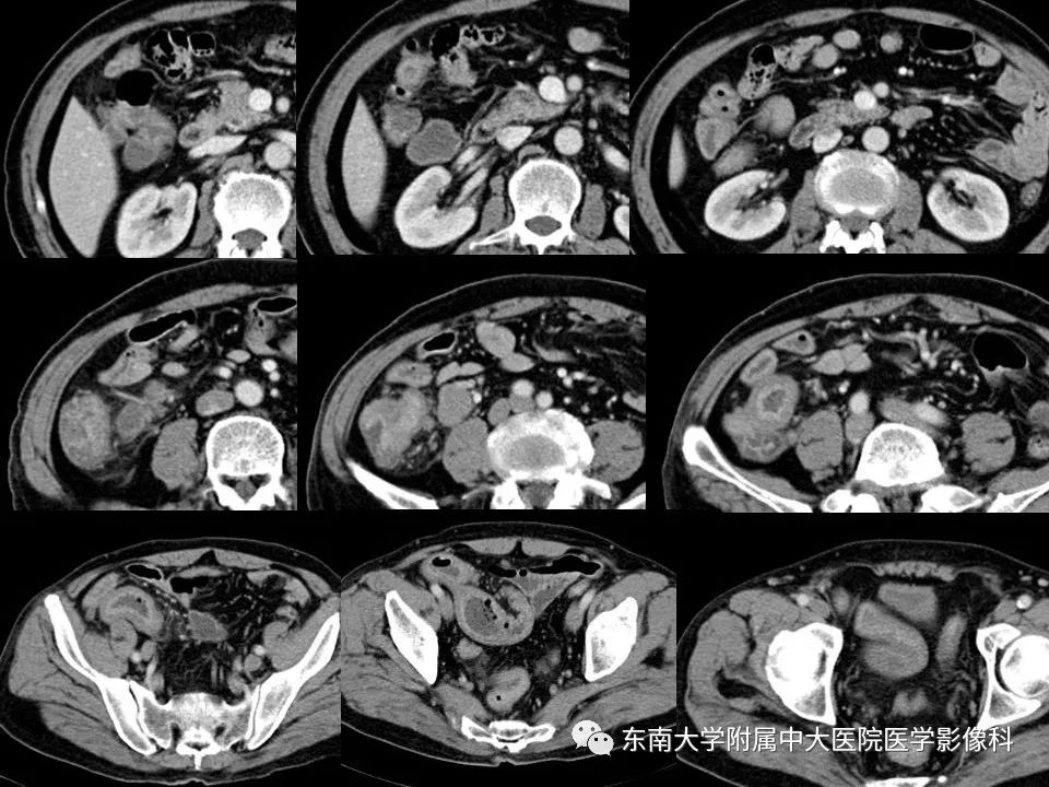 【PPT】腹部淋巴瘤影像诊断及鉴别