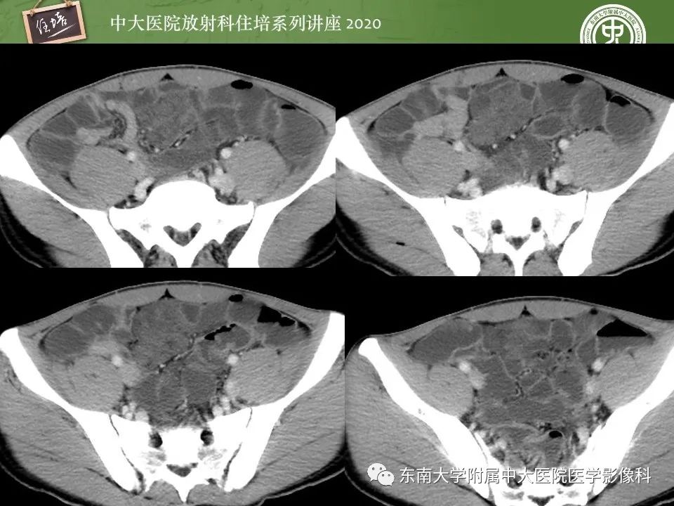 【PPT】腹部淋巴瘤影像诊断及鉴别