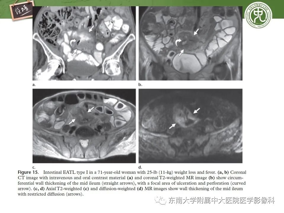 【PPT】腹部淋巴瘤影像诊断及鉴别