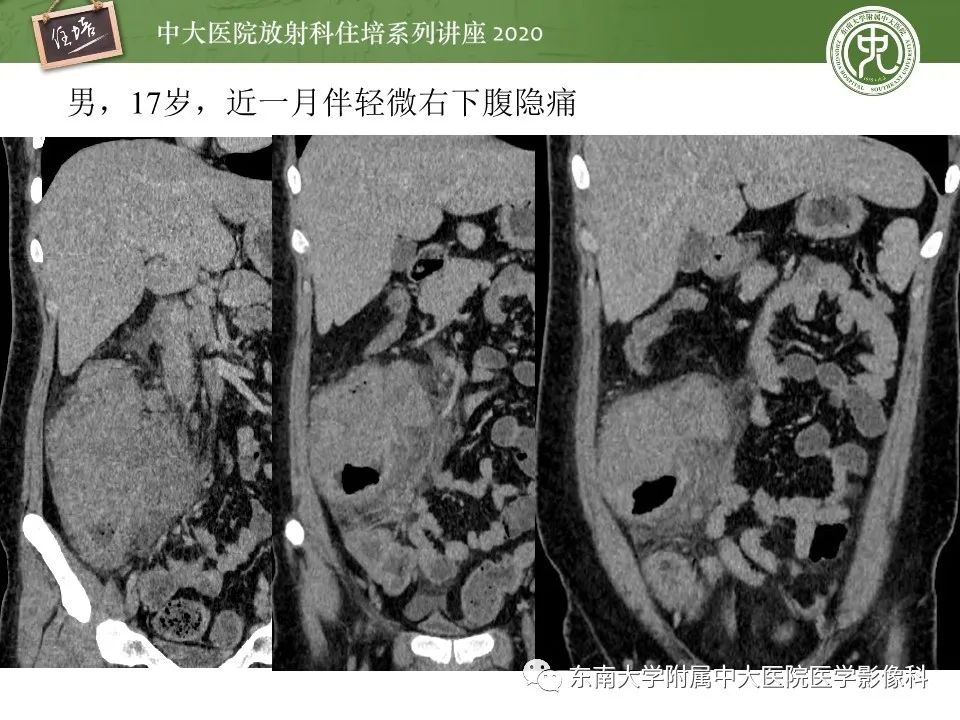 【PPT】腹部淋巴瘤影像诊断及鉴别