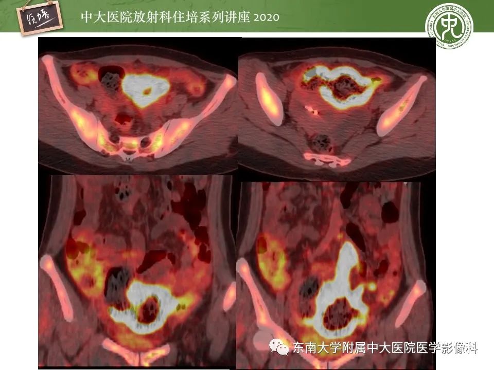【PPT】腹部淋巴瘤影像诊断及鉴别