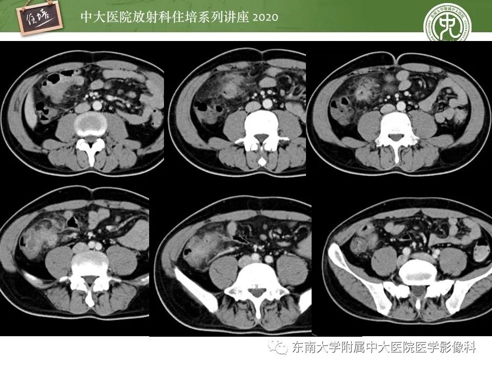 【PPT】腹部淋巴瘤影像诊断及鉴别