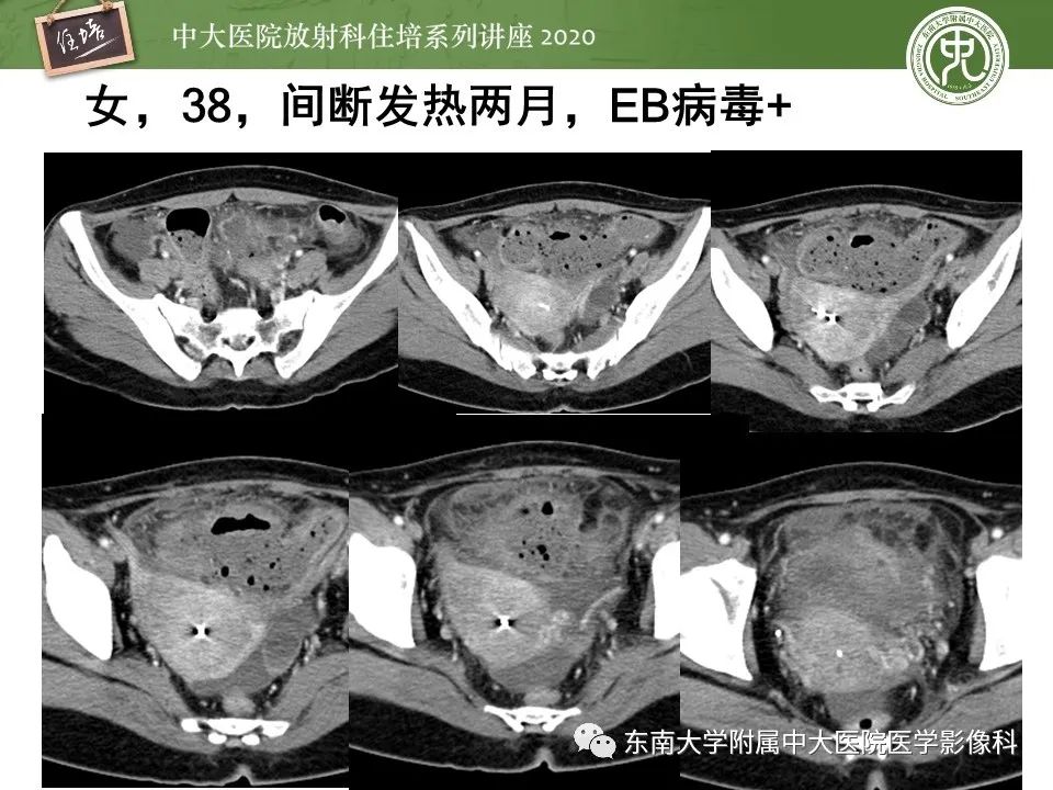 【PPT】腹部淋巴瘤影像诊断及鉴别