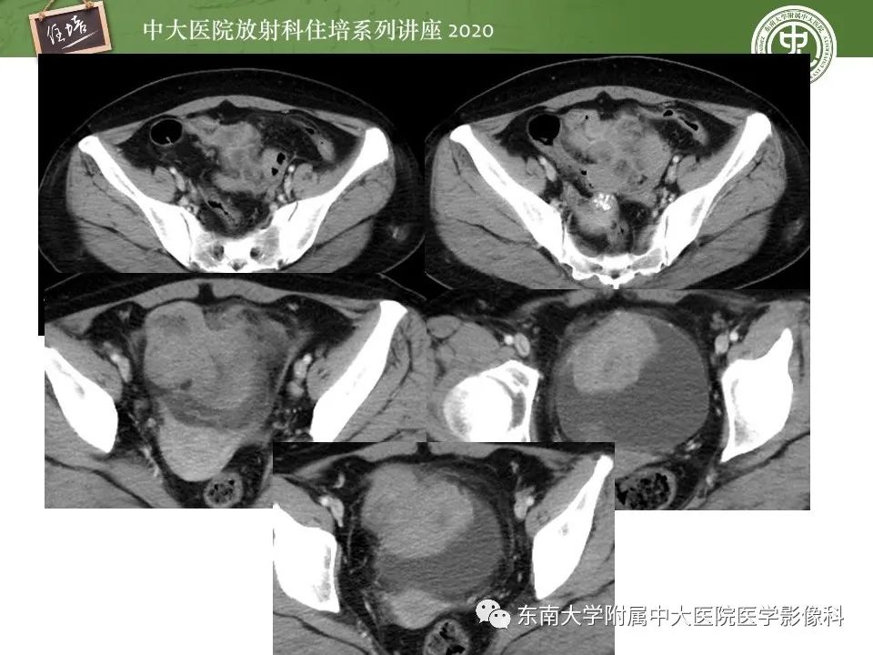 【PPT】腹部淋巴瘤影像诊断及鉴别