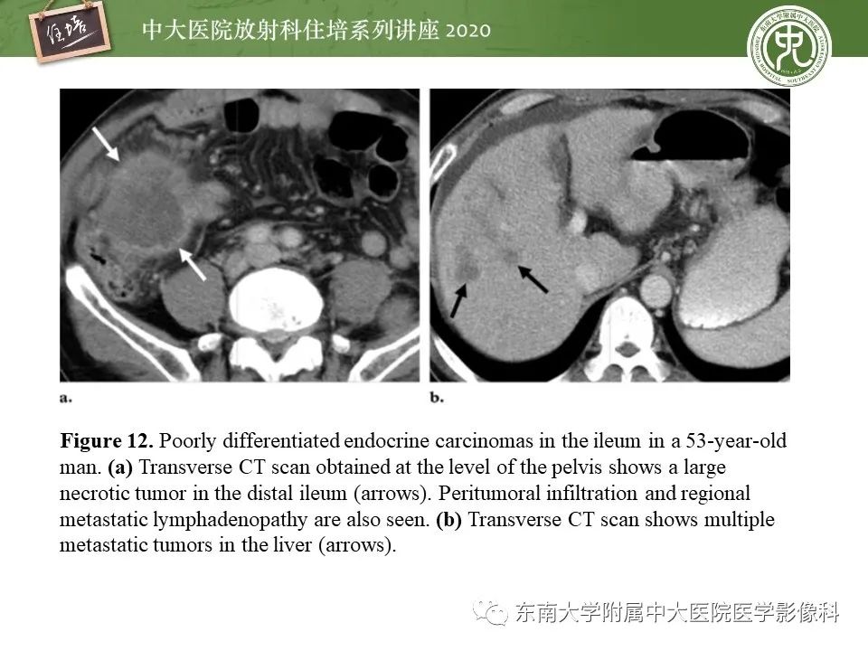 【PPT】腹部淋巴瘤影像诊断及鉴别