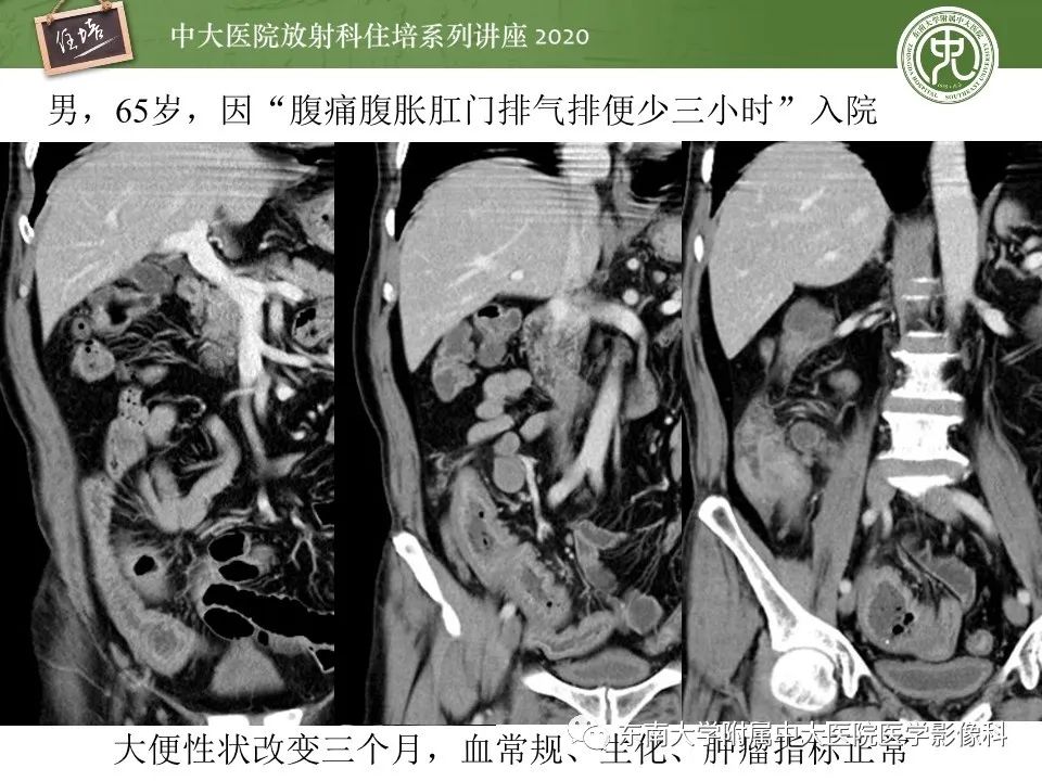 【PPT】腹部淋巴瘤影像诊断及鉴别