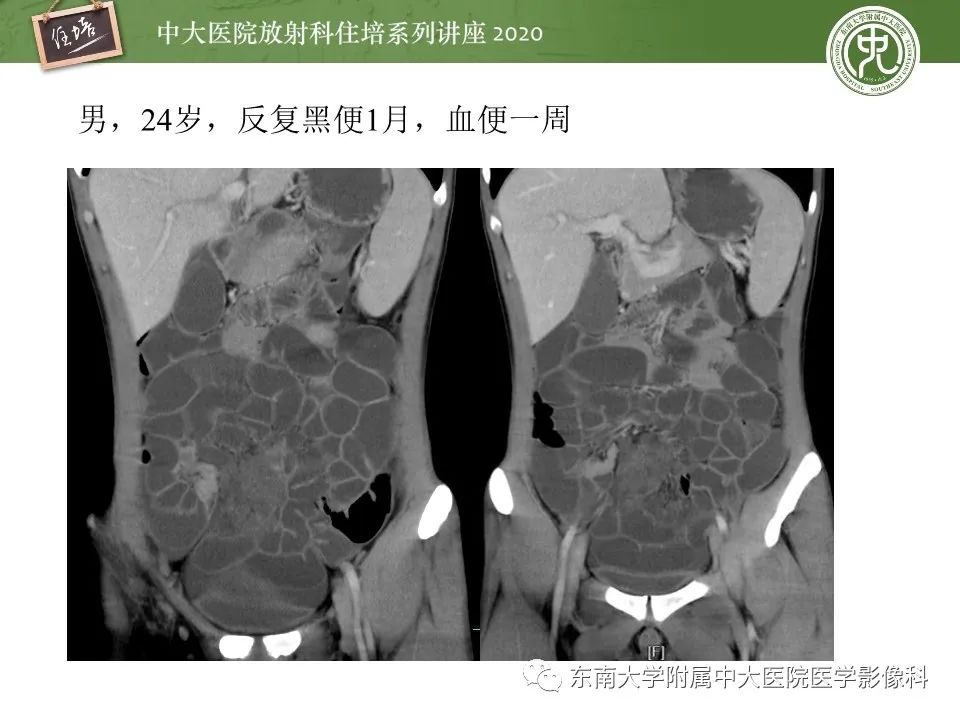【PPT】腹部淋巴瘤影像诊断及鉴别
