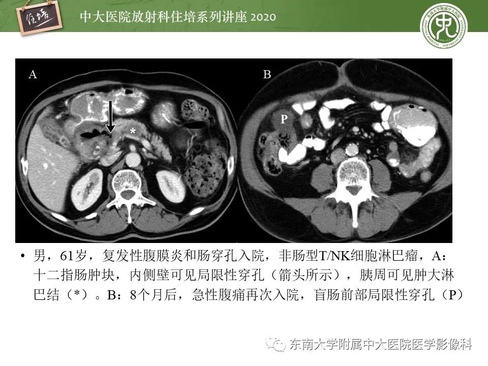 【PPT】腹部淋巴瘤影像诊断及鉴别