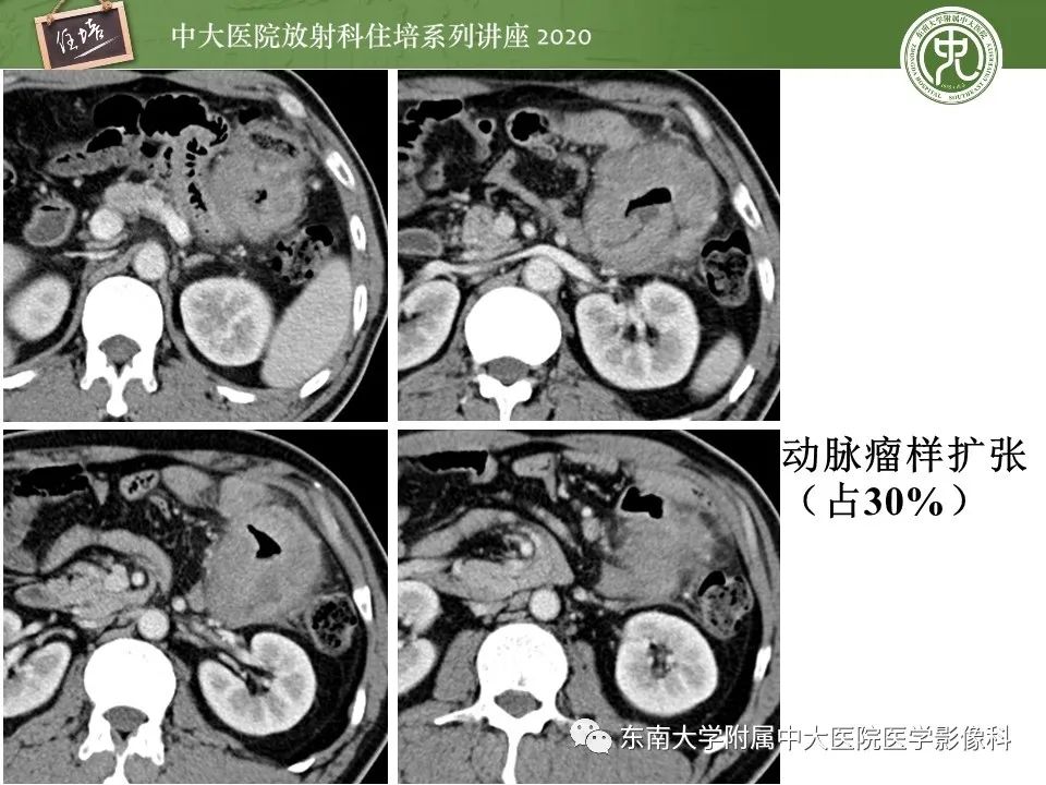 【PPT】腹部淋巴瘤影像诊断及鉴别
