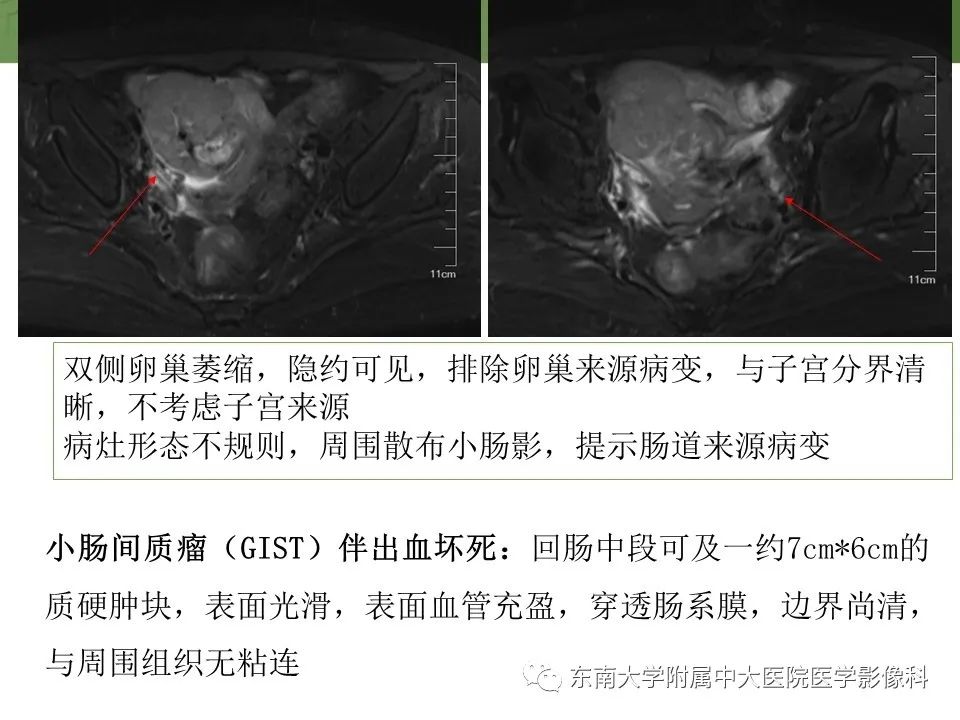 【PPT】腹部淋巴瘤影像诊断及鉴别