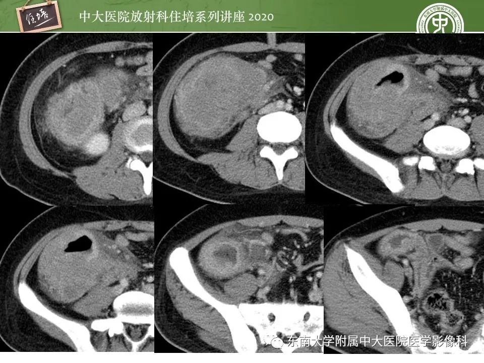 【PPT】腹部淋巴瘤影像诊断及鉴别