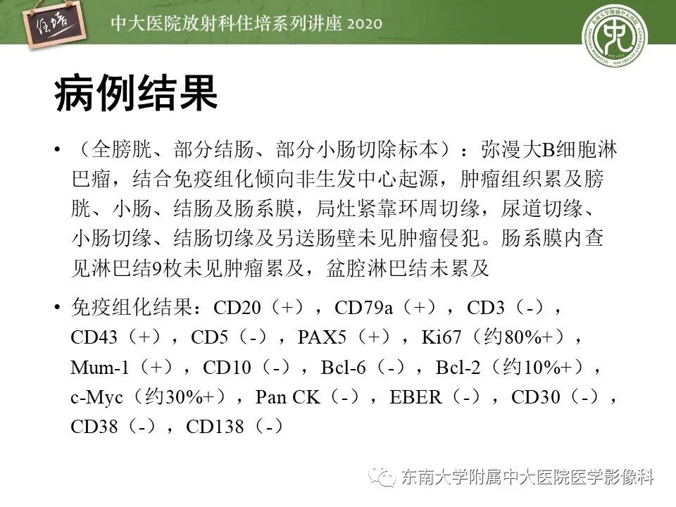 【PPT】腹部淋巴瘤影像诊断及鉴别