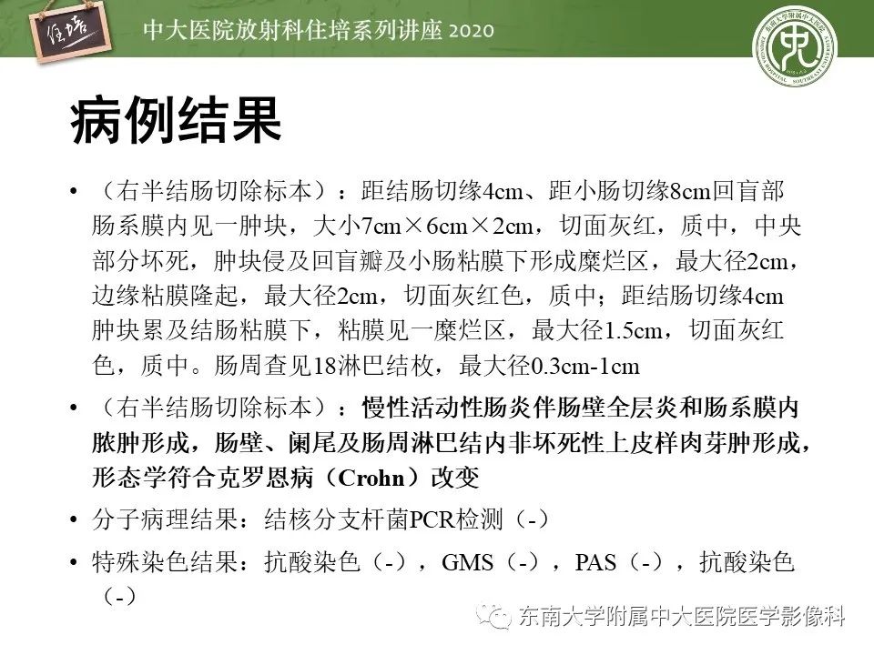 【PPT】腹部淋巴瘤影像诊断及鉴别