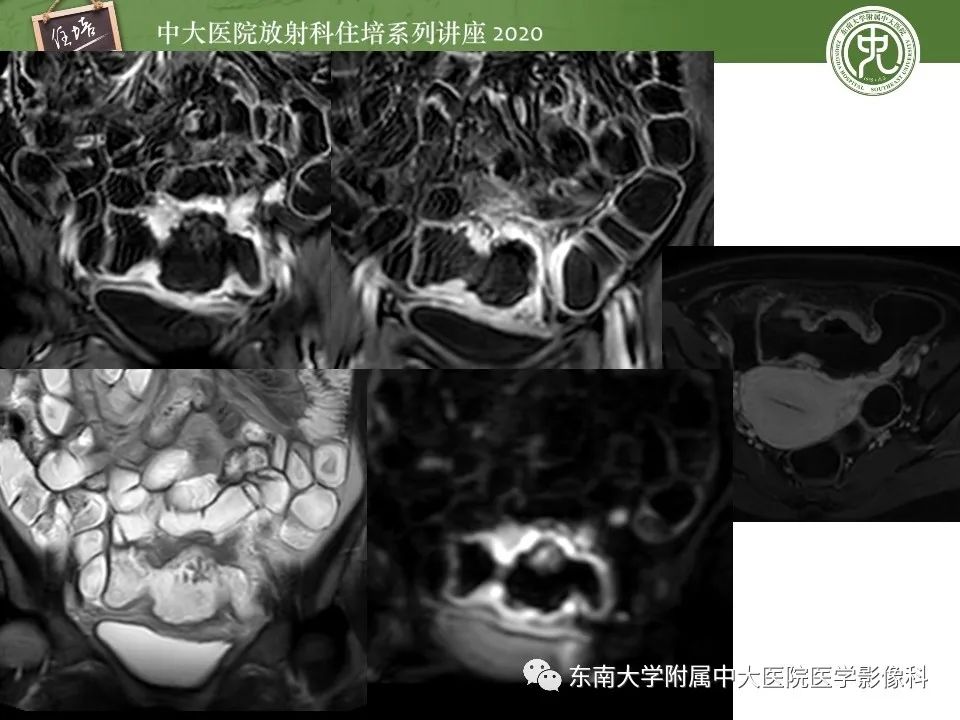 【PPT】腹部淋巴瘤影像诊断及鉴别