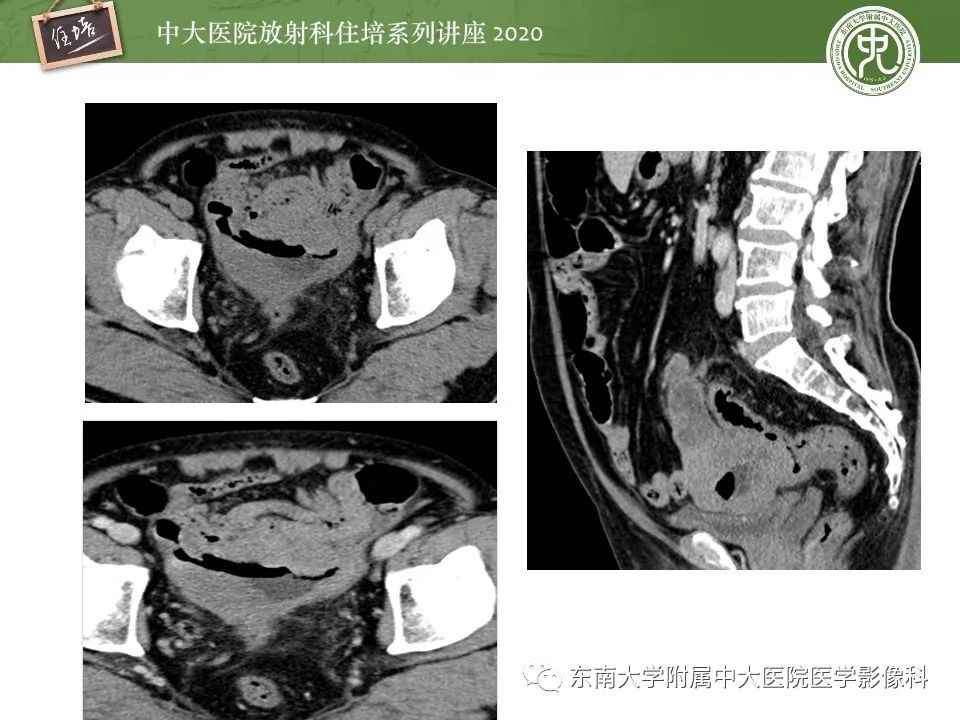 【PPT】腹部淋巴瘤影像诊断及鉴别