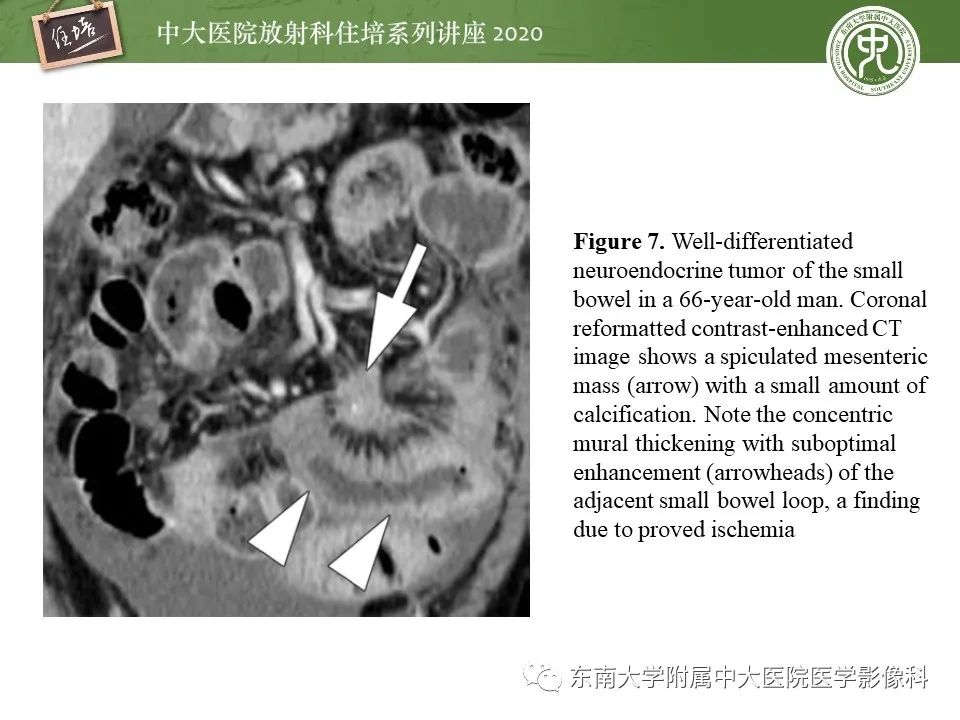 【PPT】腹部淋巴瘤影像诊断及鉴别