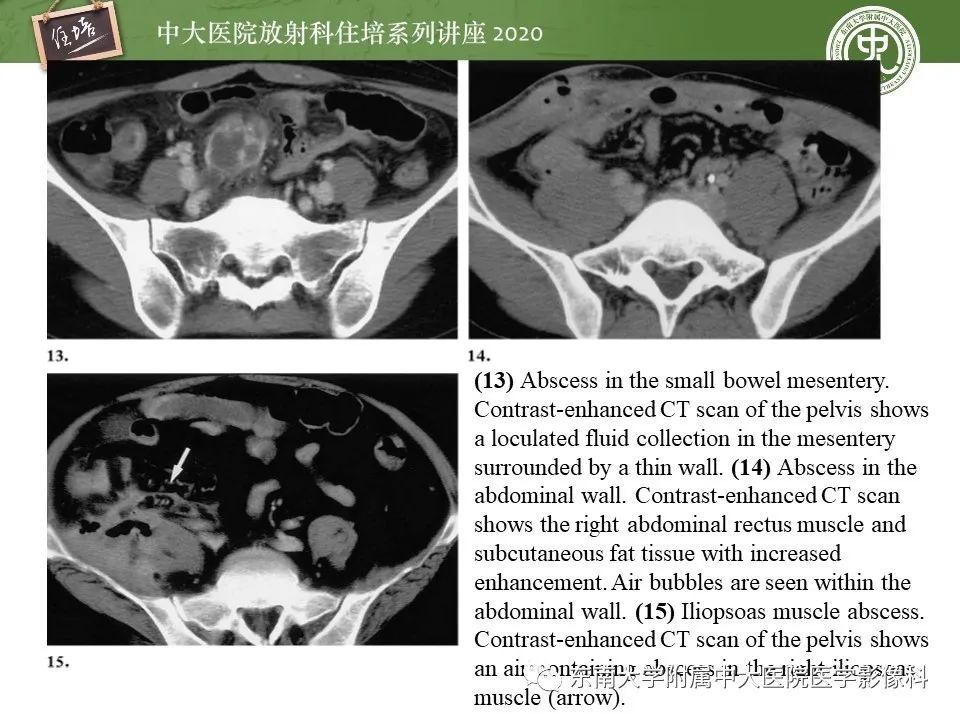 【PPT】腹部淋巴瘤影像诊断及鉴别