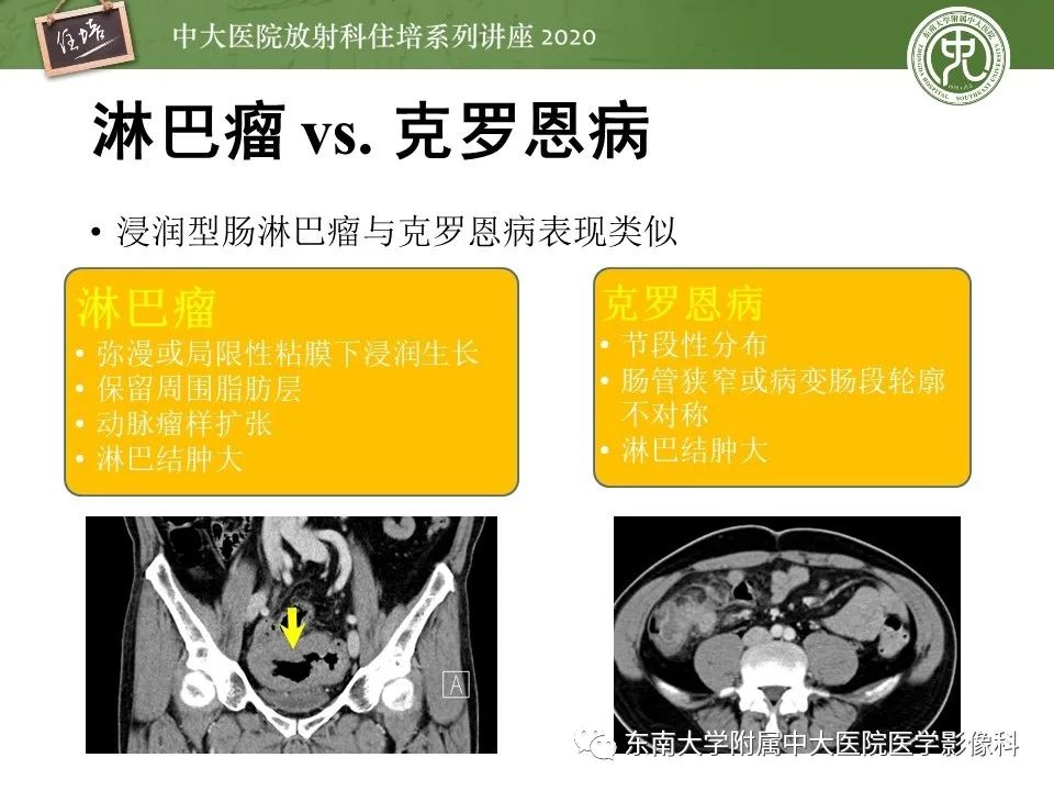 【PPT】腹部淋巴瘤影像诊断及鉴别
