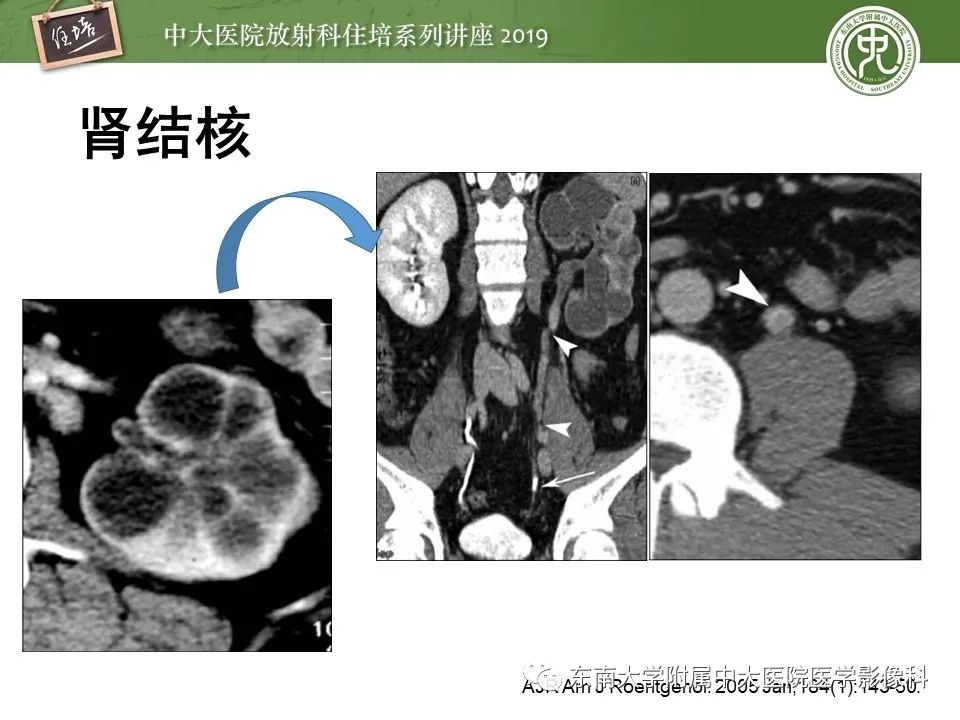 【PPT】肾脏感染性病变的影像学表现