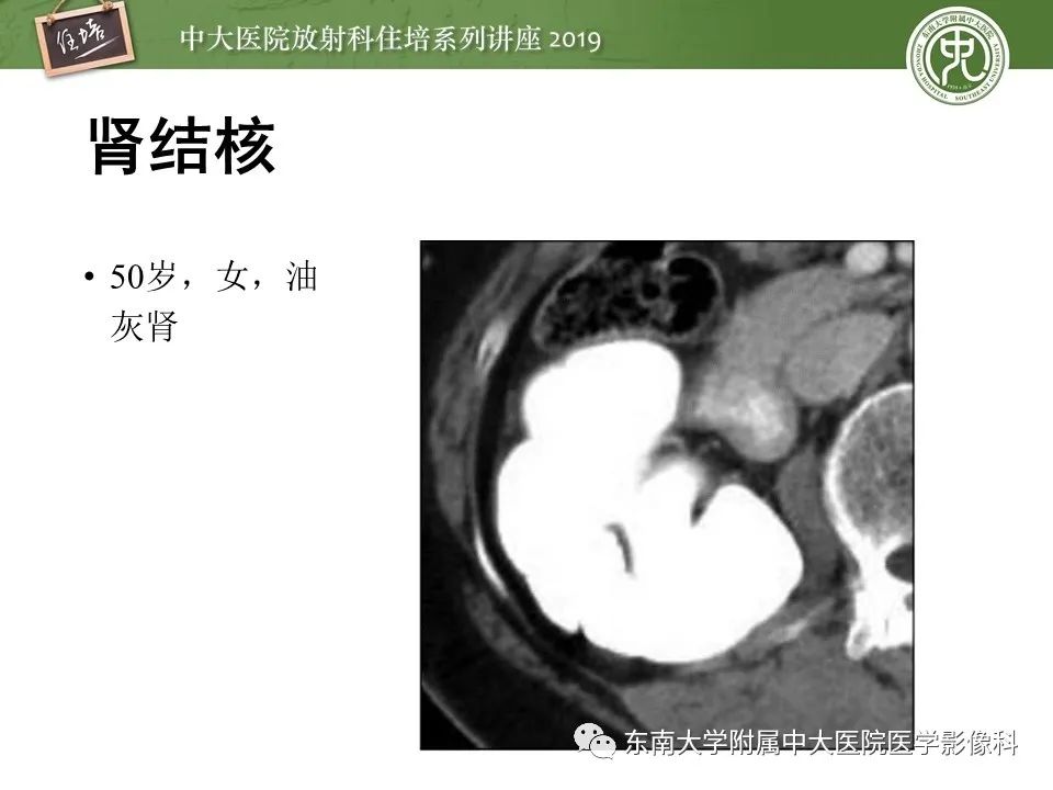 【PPT】肾脏感染性病变的影像学表现
