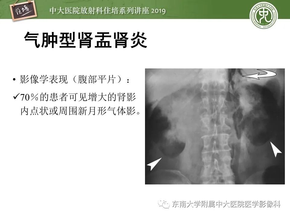 【PPT】肾脏感染性病变的影像学表现