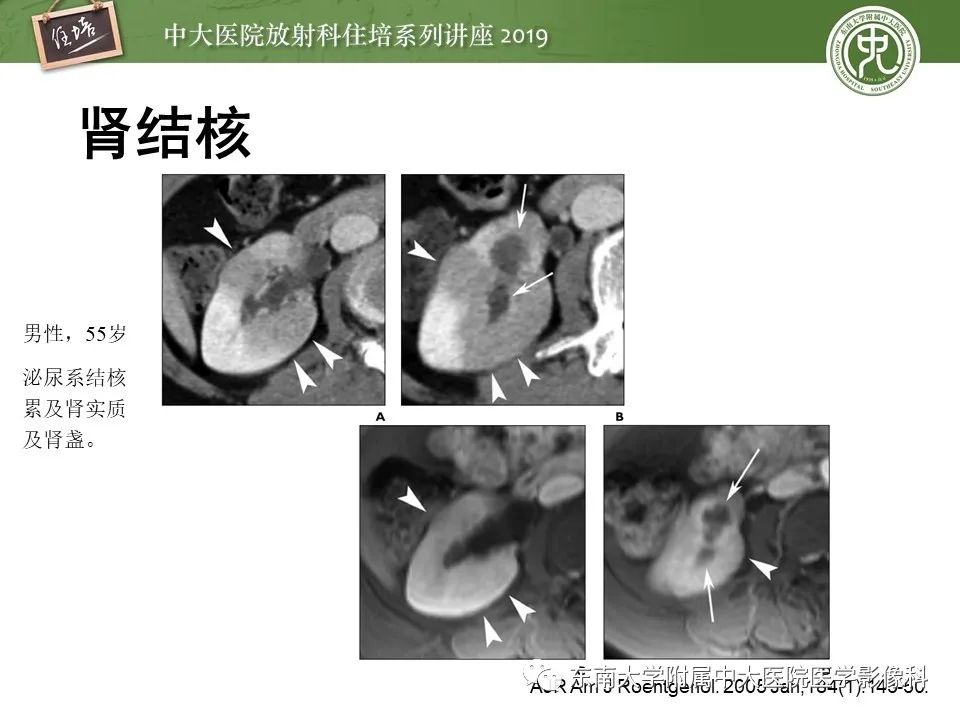 【PPT】肾脏感染性病变的影像学表现